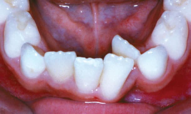 Crowding Mountain View Orthodontics in Longmont and Berthoud, CO