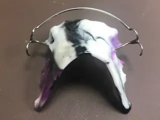 Hawley Retainer Mountain View Orthodontics in Longmont and Berthoud, CO