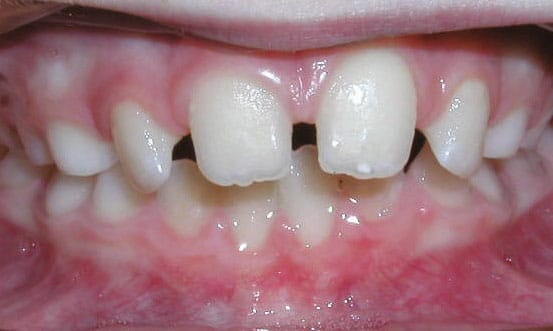 Spacing Issues Mountain View Orthodontics in Longmont and Berthoud, CO