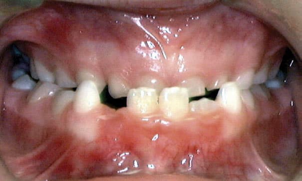 Underbite Mountain View Orthodontics in Longmont and Berthoud, CO